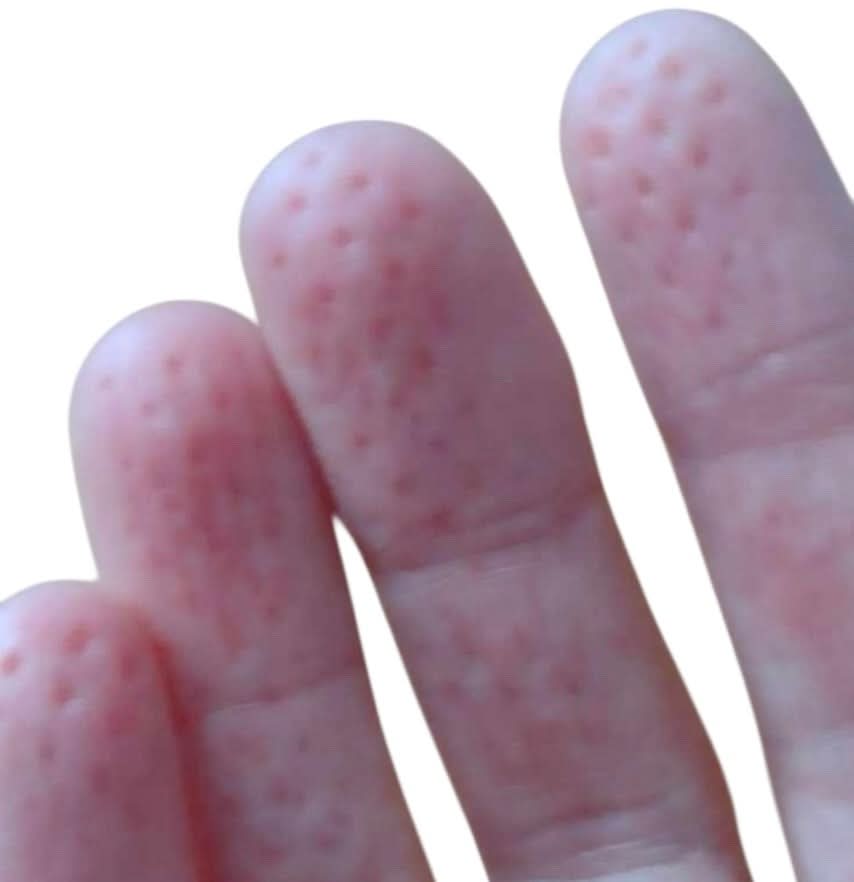 Kaiko Spikeyring Dual Pads - Sensory Fidget Ring for Calm & Focus